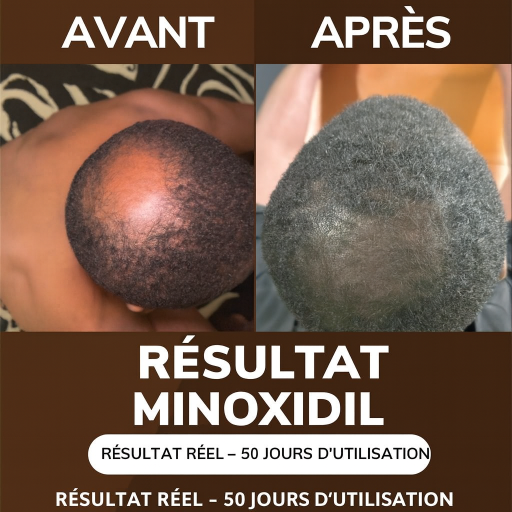 Sérum Minoxidil & Dermaroller – Repousse Capillaire Rapide et Naturelle